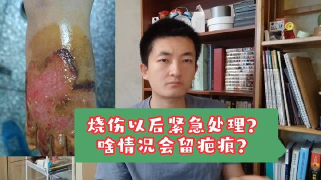 2岁女童打翻爸爸泡面被深度烫伤 ，医生：烫伤面积占体表面积20%