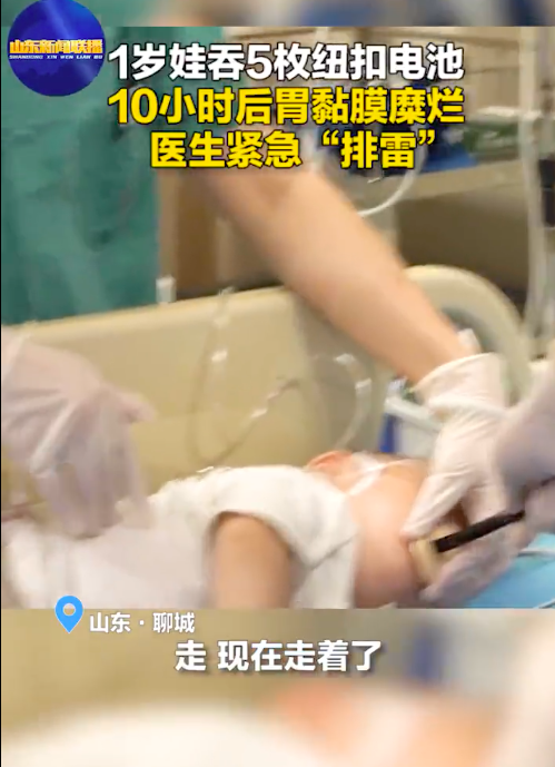 1岁婴儿吞5枚电池10小时后取出 医生紧急“排雷”
