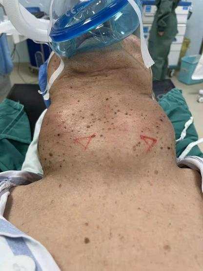 88岁老人脖子慢慢变粗，半年时间不能吃饭、呼吸困难