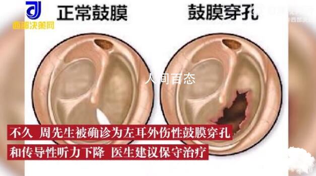 男子打蚊子把自己左耳鼓膜打穿孔 被打耳朵鼓膜穿孔