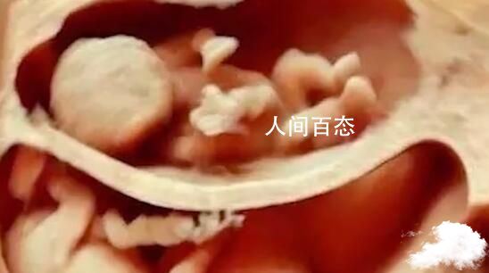 双胞胎肚内打架出生后淤青?医生辟谣 双胞胎在肚子里打架会受伤吗