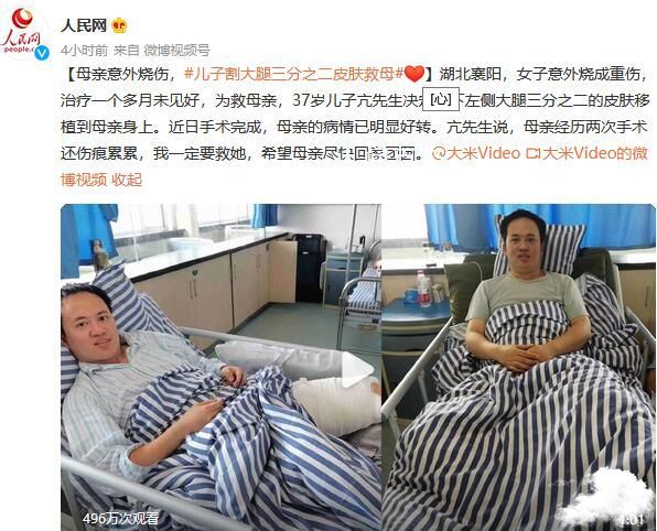 儿子割大腿三分之二皮肤救母 希望母亲尽快回家团圆