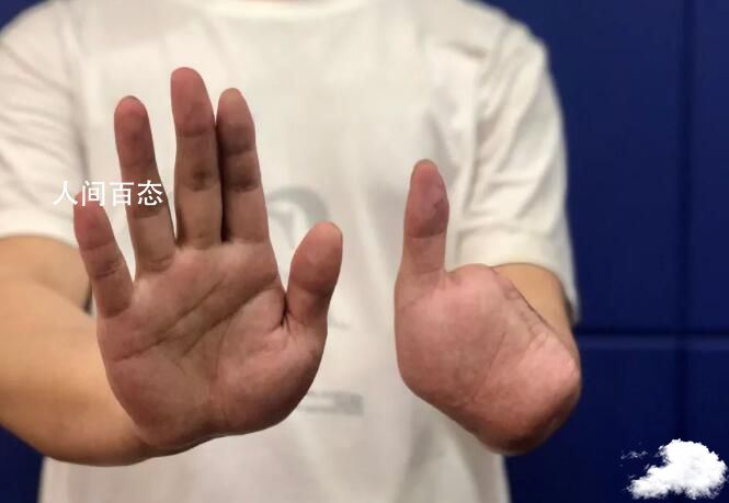 男子冒死从缅北逃回讲述惨痛遭遇 不听话的人都会被打死 在缅北被打死