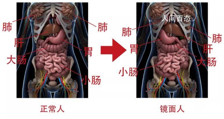女子五脏六腑全部反着长 目前恢复良好已顺利出院